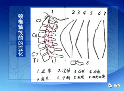 收藏丨手把手教你在x线上如何测量「颈椎生理曲度变直」