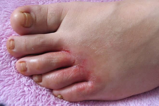 脚气,系真菌感染引起,其皮肤损害往往是先单脚发生,数周或数月后才