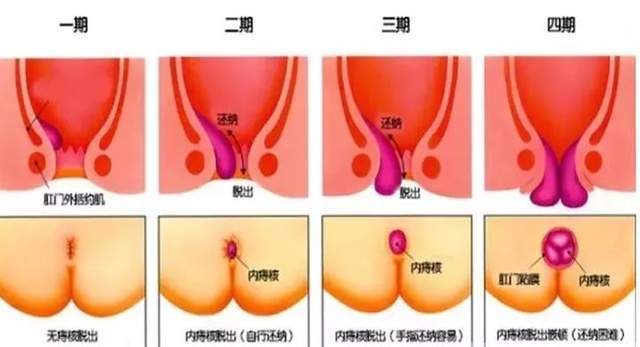洗屁股有助于缓解痔疮吗 3a43d67ed4c94560a210bc941424ace6.jpeg
