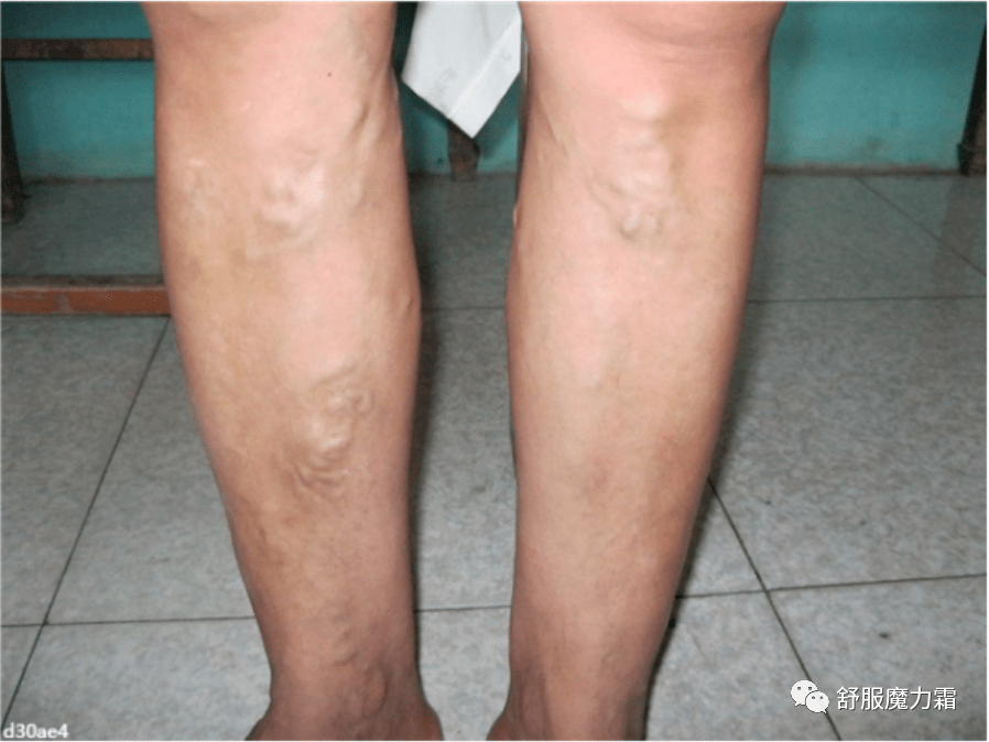 很多人表示站久了,小腿会出现酸胀,发麻的感觉,晚上睡觉时总觉得腿累