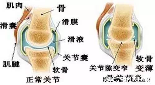 膝盖关节有骨刺走路疼痛怎么办膝关节疼痛真的是因为骨刺吗