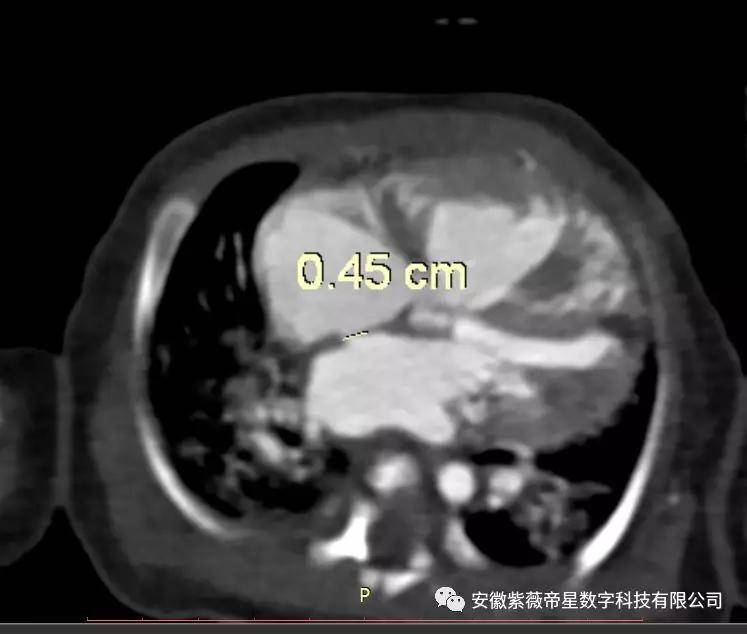 紫薇帝星案例分享当房间隔缺损遇上人体三维可视化