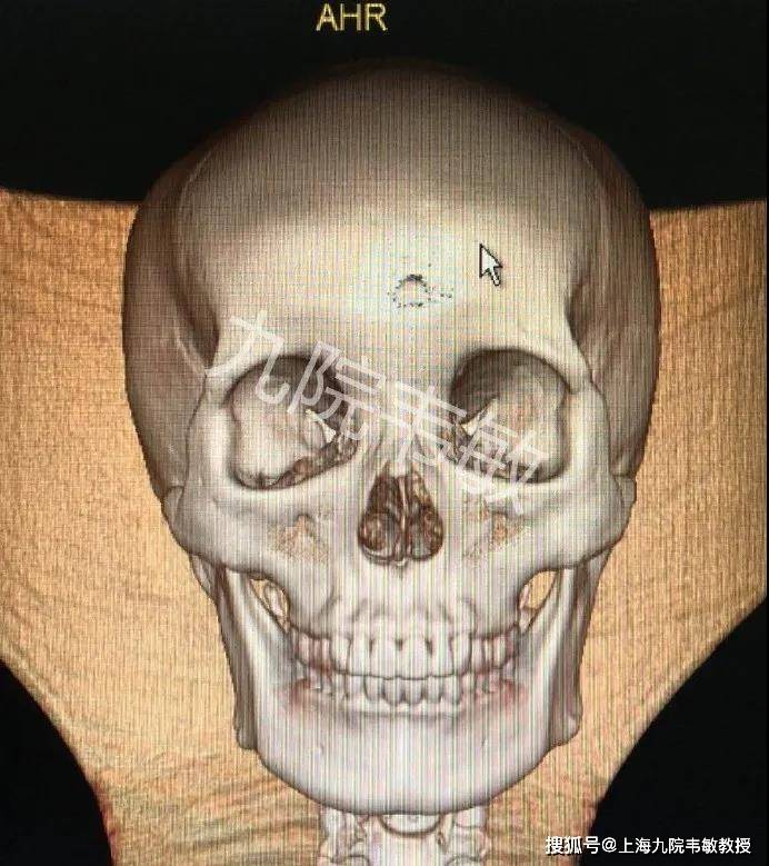 九院韦敏教授丨术前检查对轮廓手术的重要性