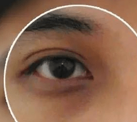 肾上腺素红黑眼圈图片
