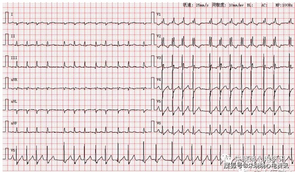 第1266期 房颤 完右伴左后分支传导阻滞
