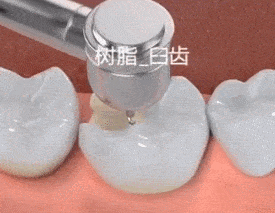 补牙补牙,补完的牙为什么还会掉?_牙齿