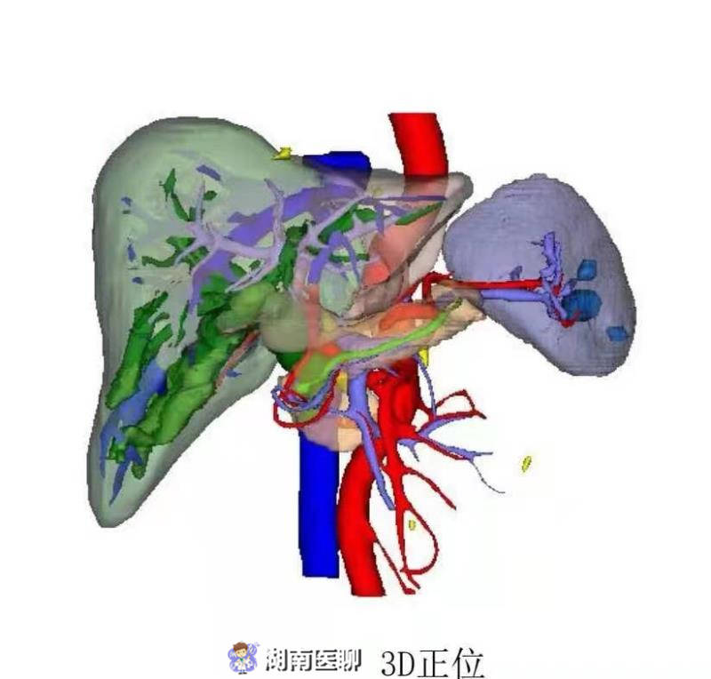 老婦腹痛月餘現膽管炎,不開刀也能精準取石?