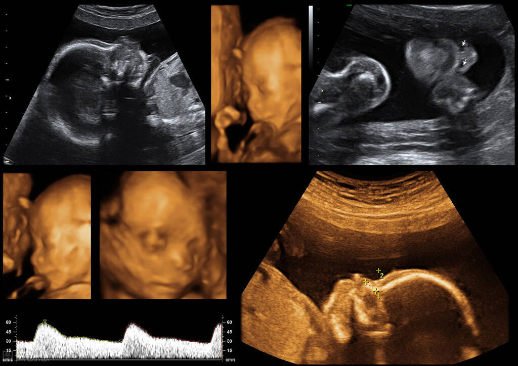 孕期3项排畸检查很关键,想生健康聪明宝宝,一样都不可错过