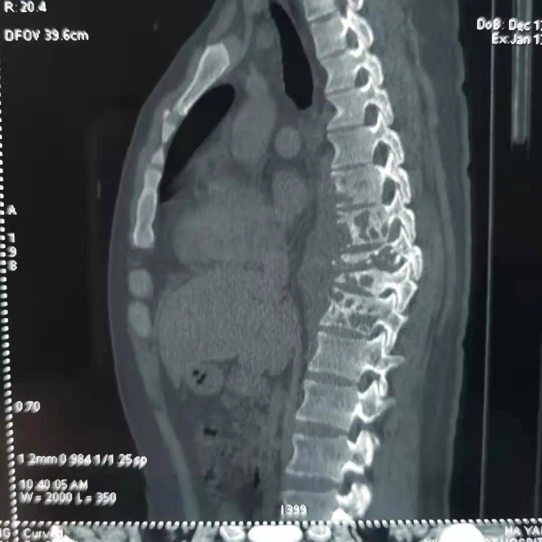 脊柱|外科医生有妙招 3D打印模型模拟手术减风险