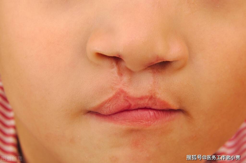 家族没有兔唇宝宝为何会有 除了家族遗传还有这几个原因 影响 家族没有兔唇宝宝为何会有 除了家族遗传还有这几个原因 影响