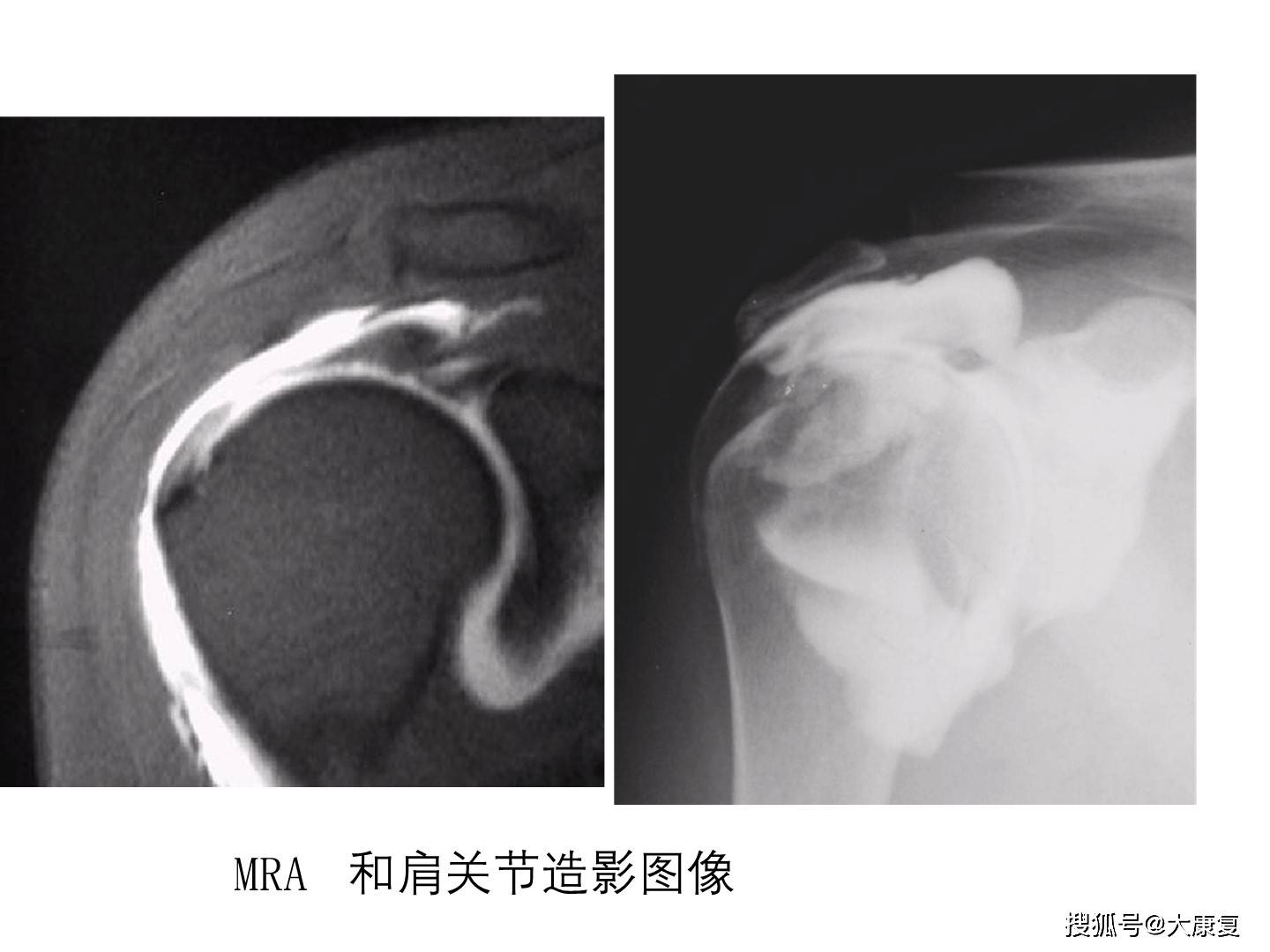 肩關節運動損傷影像診斷