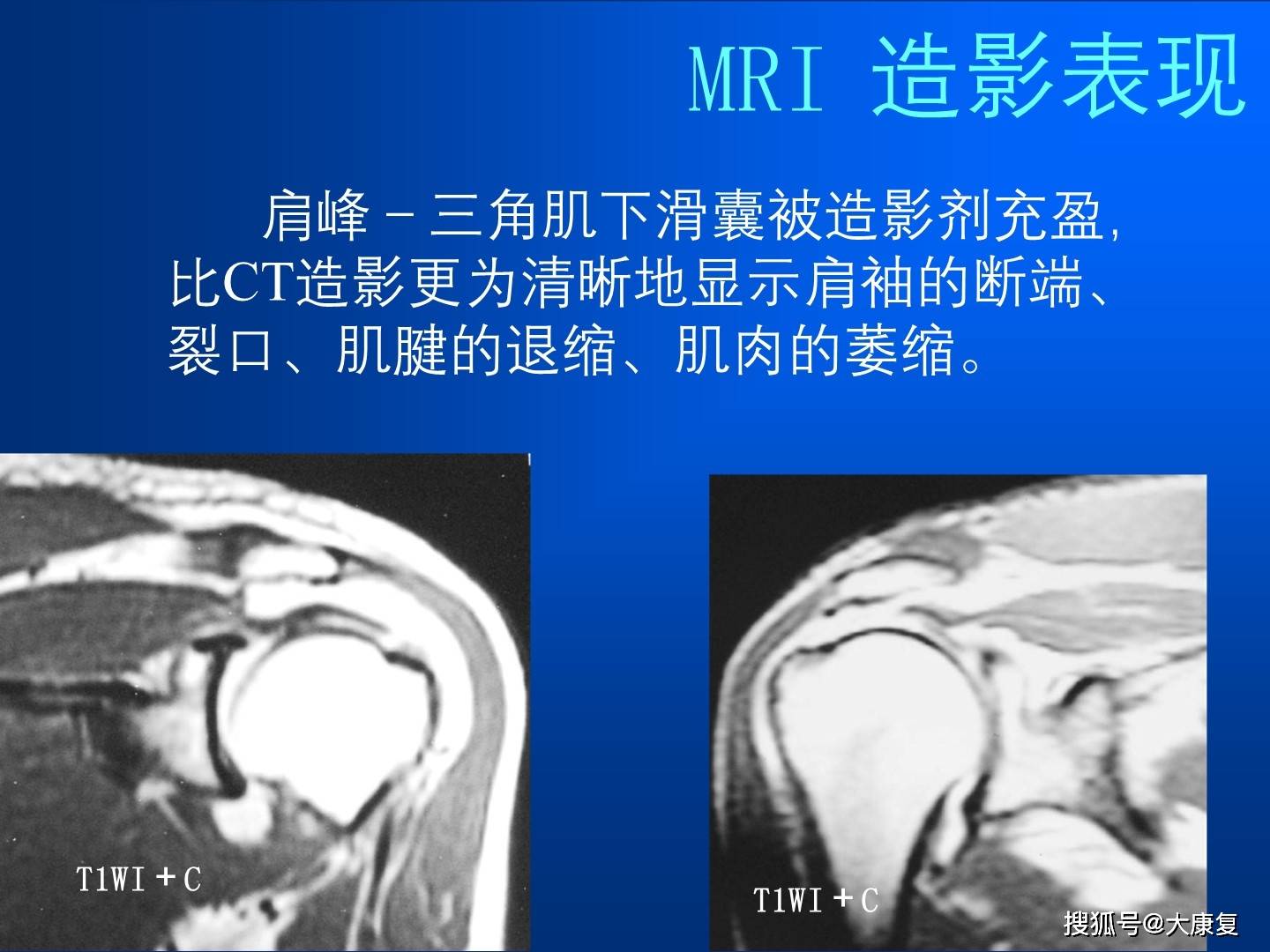 肩袖損傷mri診斷