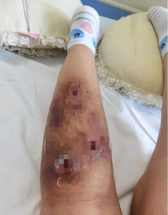 是一个吧友分享自己打溶脂针打到双腿肌肉溶解险些截肢的悲惨经历