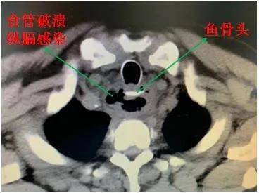 鱼骨穿透食管险些丧命异物卡喉这些事千万别做