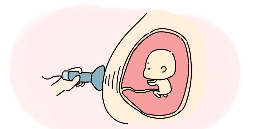 胎儿心脏彩超卡通图片