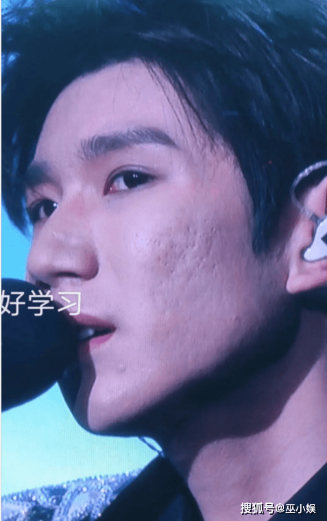 原创王源近照曝光满脸痘印似大叔小鲜肉翻车被嘲颜值下滑