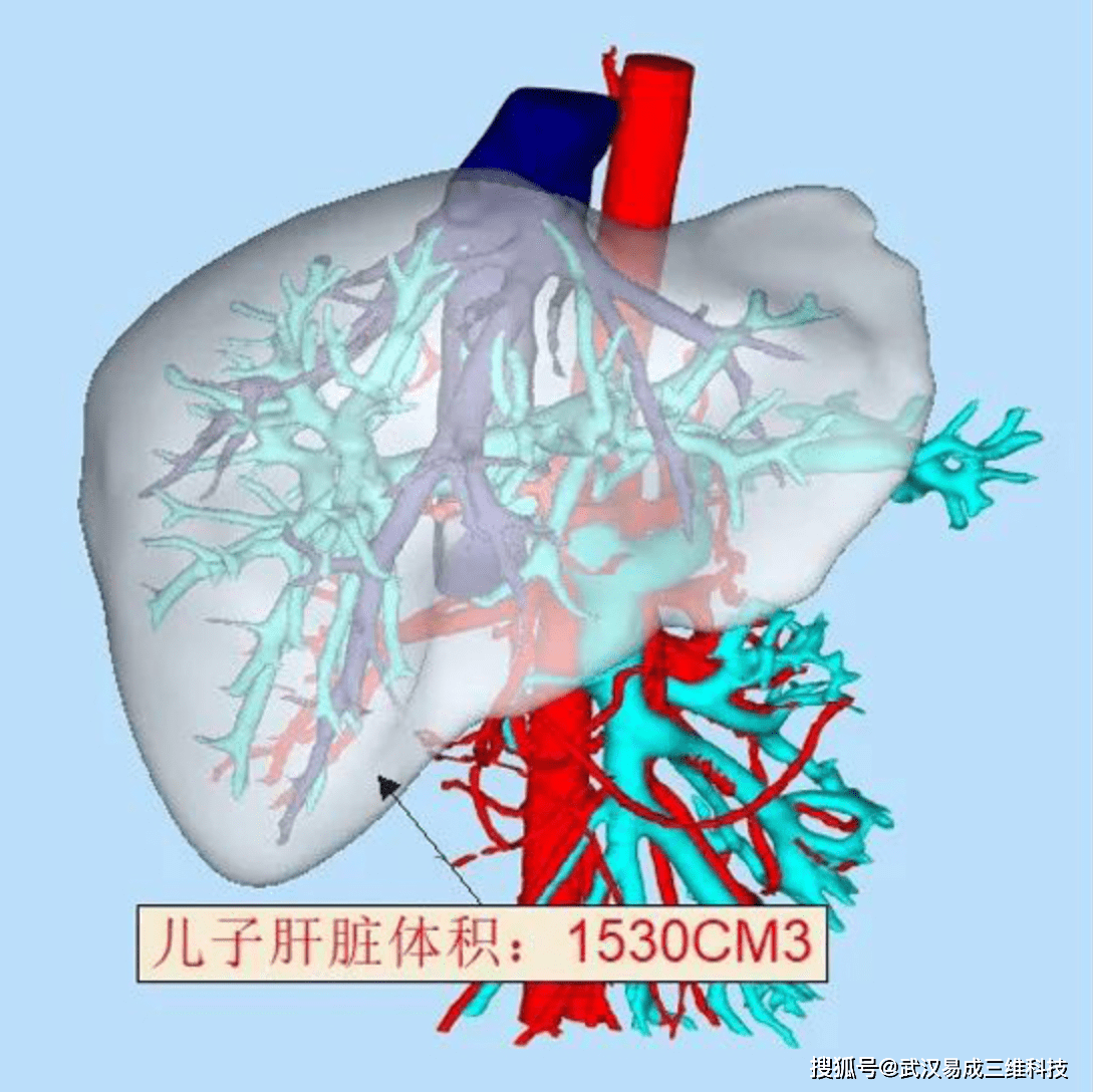生物医疗3d打印技术助力高难度肝移植手术_肝脏