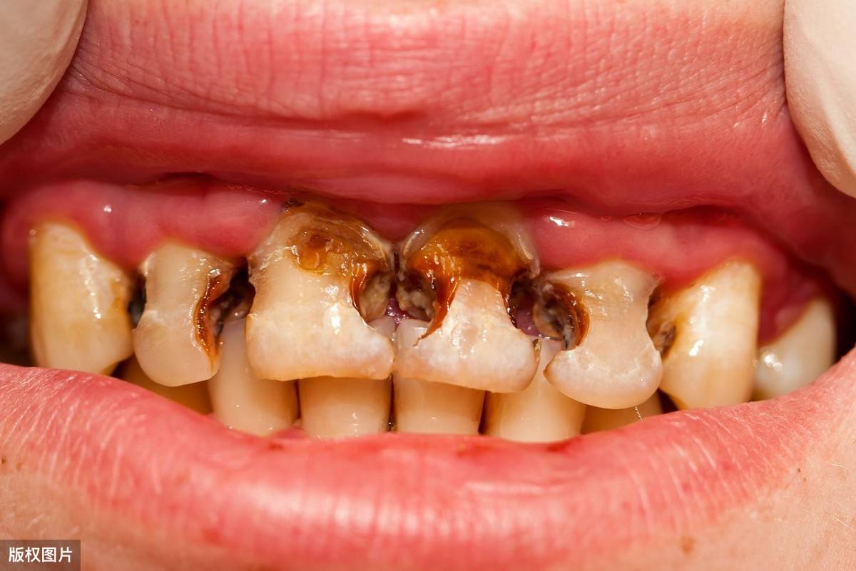 干槽症牙洞的样子图片