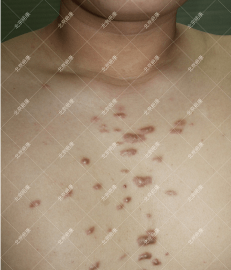 瘢痕疙瘩照片胸前图片