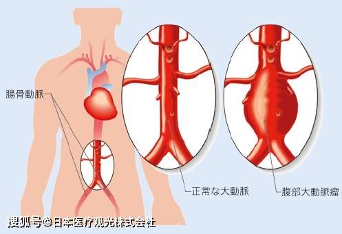 什么是动脉瘤会产生什么症状 4fec62b9a65b45469e5293d4ae7de8fc.jpeg