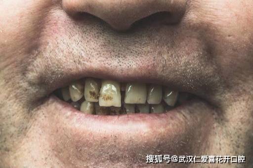 长期吸烟对你的口腔健康到底造成了多大的伤害?_牙齿