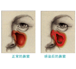 貴陽銘仁耳鼻喉醫院鼻涕有臭味是怎麼回事當心是黴菌性鼻竇炎作怪