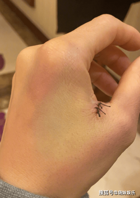 原创容祖儿剪刀插进左手虎口留下2条毛毛虫庆幸没有影响节目