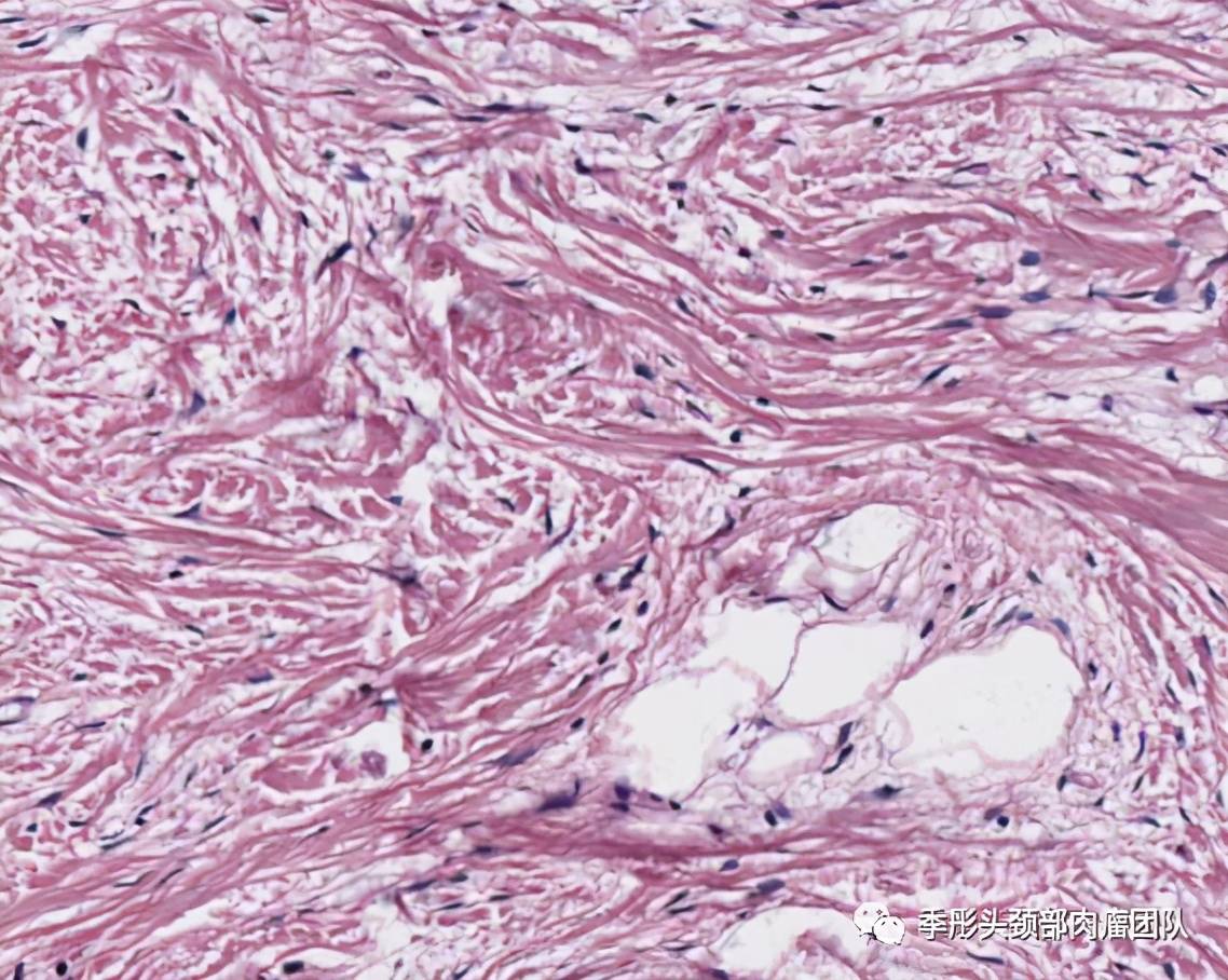 头颈部炎性肌纤维母细胞瘤是怎么回事