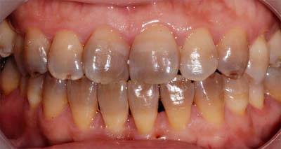 牙齿发黄怎么办如何美白比较好