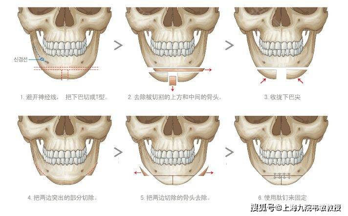 九院韦敏科普丨哪些下巴形态需要手术改善?