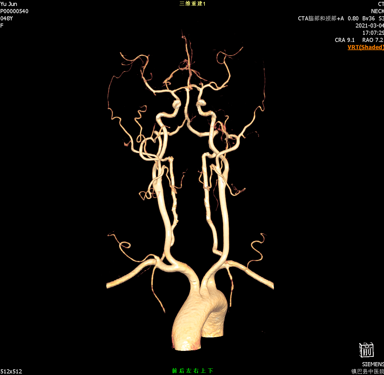 頭頸部及體部血管cta(血管造影),頸動脈血管成像分析,腦動脈環成像