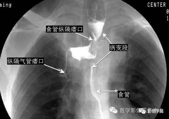 10种食管钡餐常见疾病图解