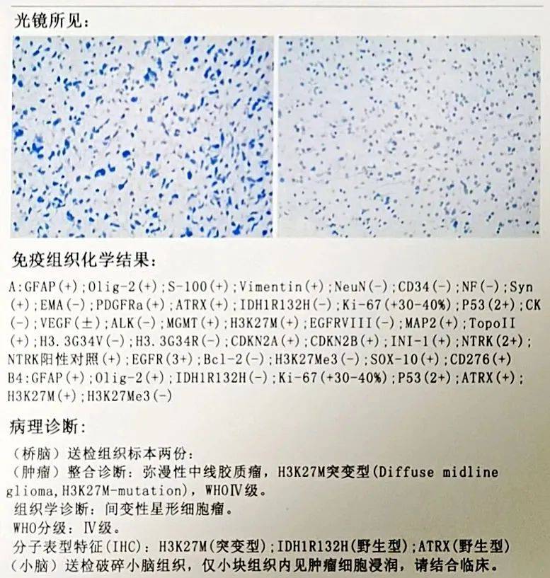 胶质瘤病理报告图片
