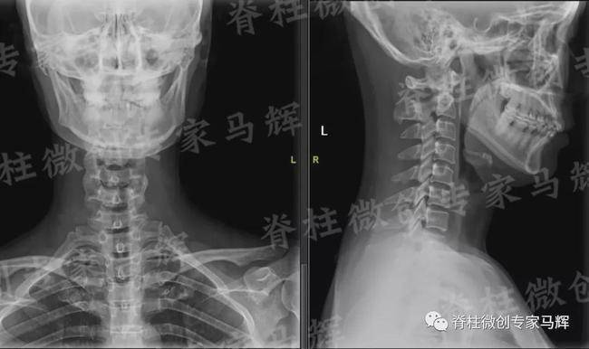 双侧神经根受压怎么办
