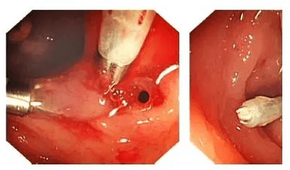 7旬老伯"老胃病"长期吃止痛药致胃穿孔!_胃肠