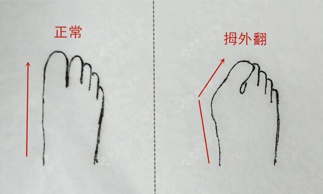 千万不要错过拇外翻大脚骨保守治疗的黄金时机河南安阳航康医疗矫形