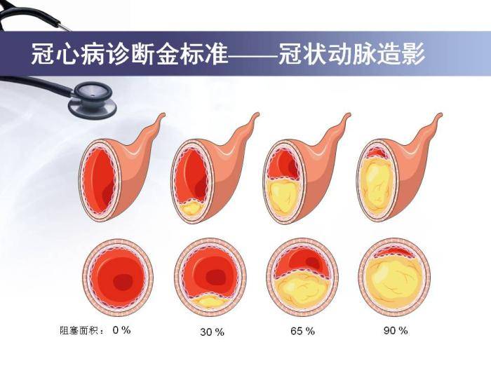 "是冠状动脉造影,它是一种介入性的检查,能直观心脏血管狭窄的情况