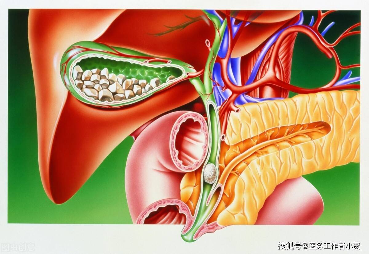 胆囊结石会发展成胆囊癌吗 55岁以上的老人有这些症状的要注意 患者