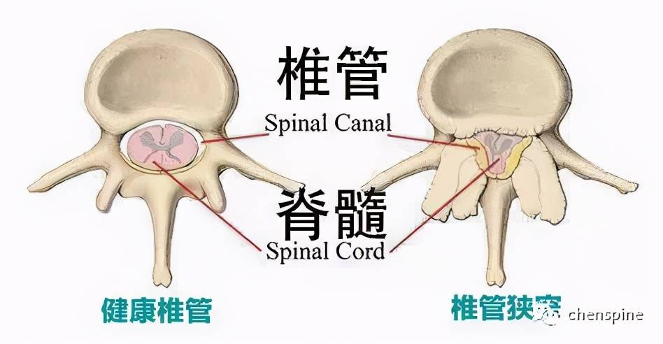 腰椎管狭窄常见问题解答 治疗