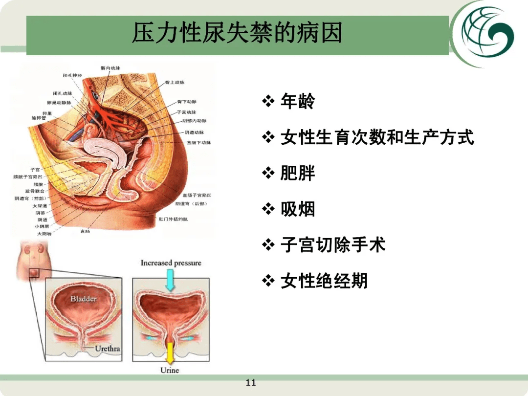 关注女性尿失禁健康大课堂