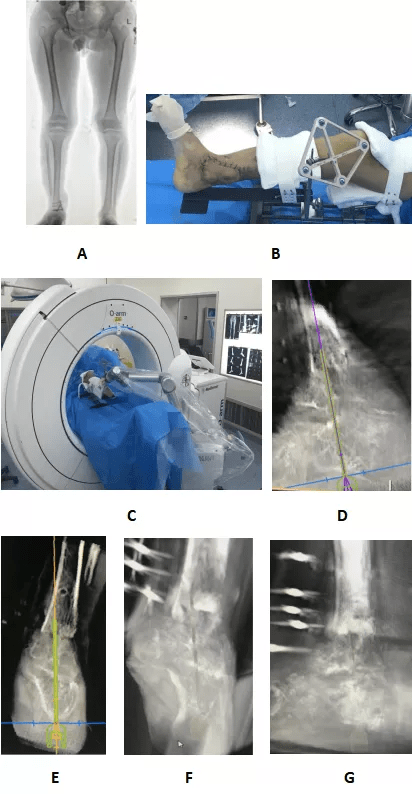 影像|西北首例！机器人辅助髓内钉踝关节融合联合外固定架骨延长术