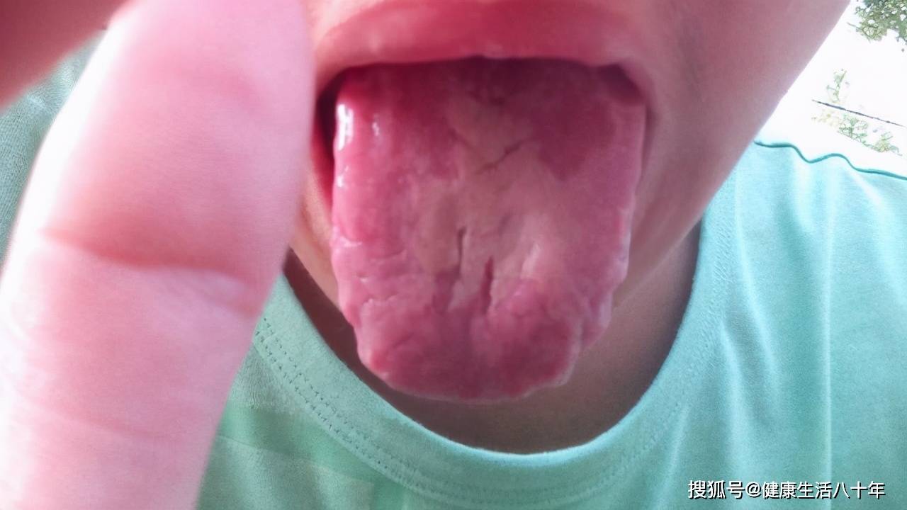 舌边有齿痕是阳虚吗 脾胃虚寒是阴虚还是阴虚