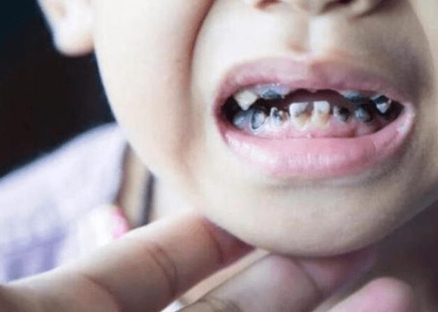 儿童吃糖坏牙恐怖图片图片