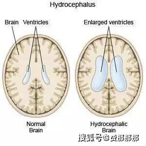 怎么治疗中脑导水管狭窄性脑积水?