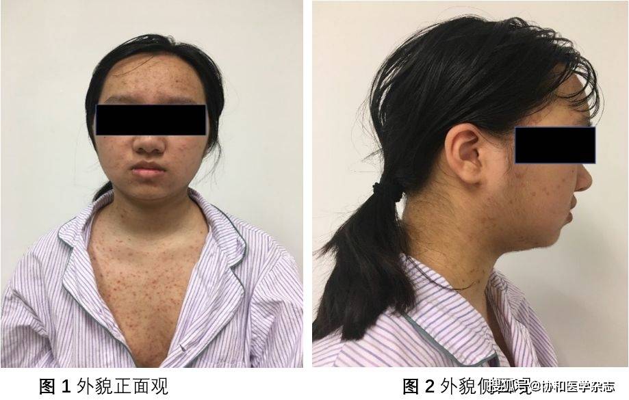 花季少女全身痤疮体毛增多声音低沉男性化肾上腺巨大肿瘤惹的祸