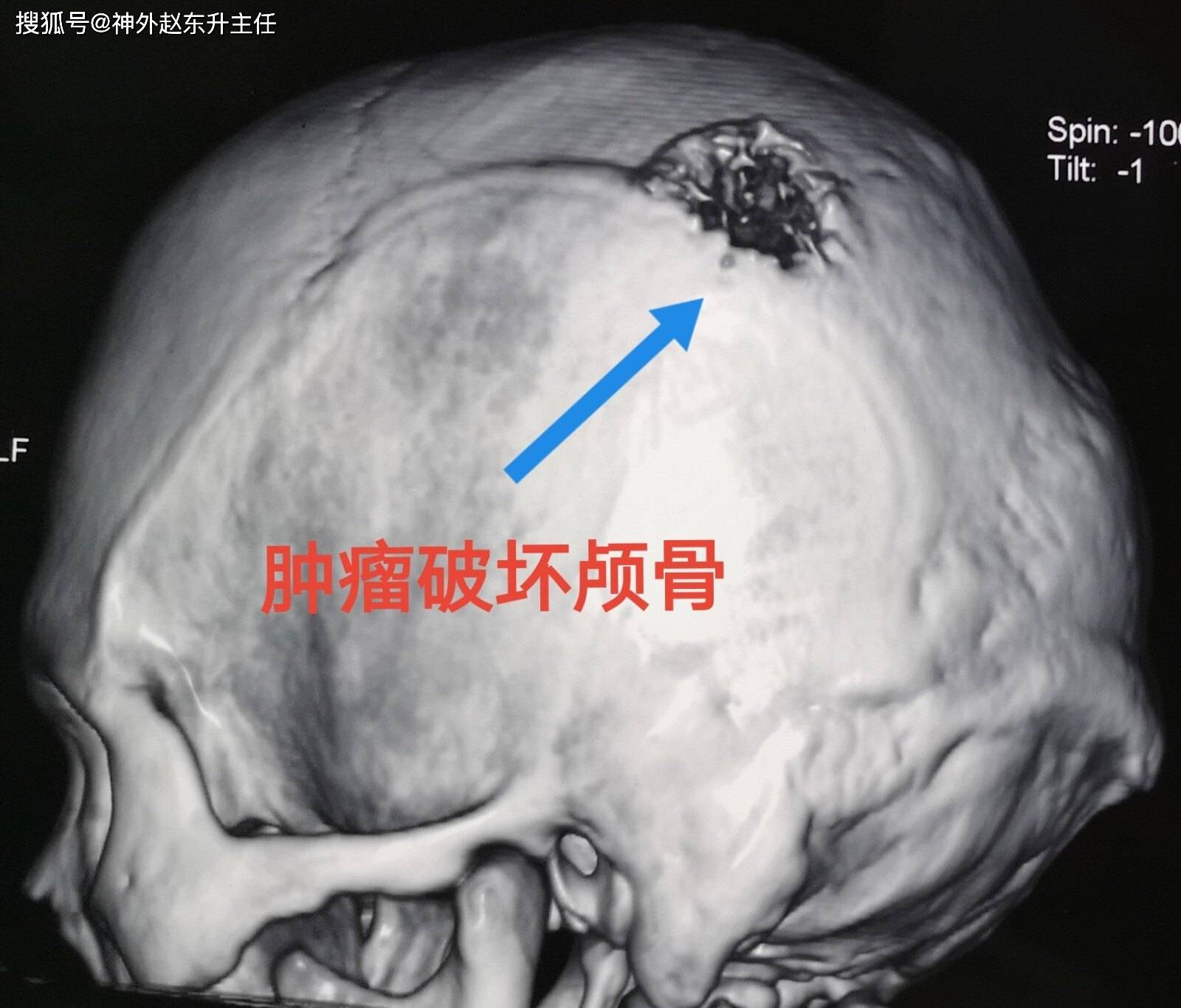 原創頭部一個小疙瘩快速長大一定要當心有可能是惡性轉移瘤