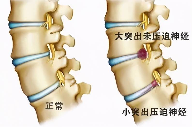 誤區8.腰椎間盤突出症不一定有腰疼,而腰疼更不一定是腰椎間盤突出症