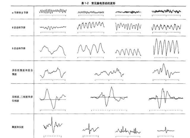 儿童脑电图基础与判读解析 波形