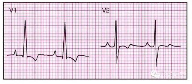 最全面的异常心电参考图建议收藏