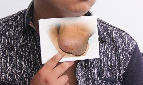 为什么会得甲状腺癌晚期 d72c9f45d654427790753e69c4f67340.jpeg